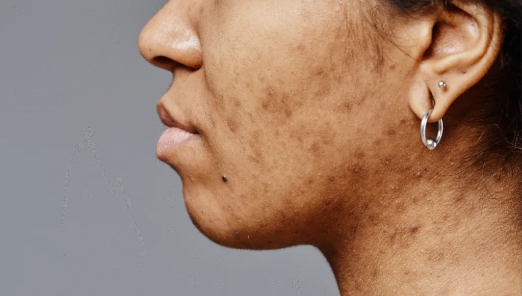 Hyperpigmentation Treatments Near You in Atlanta