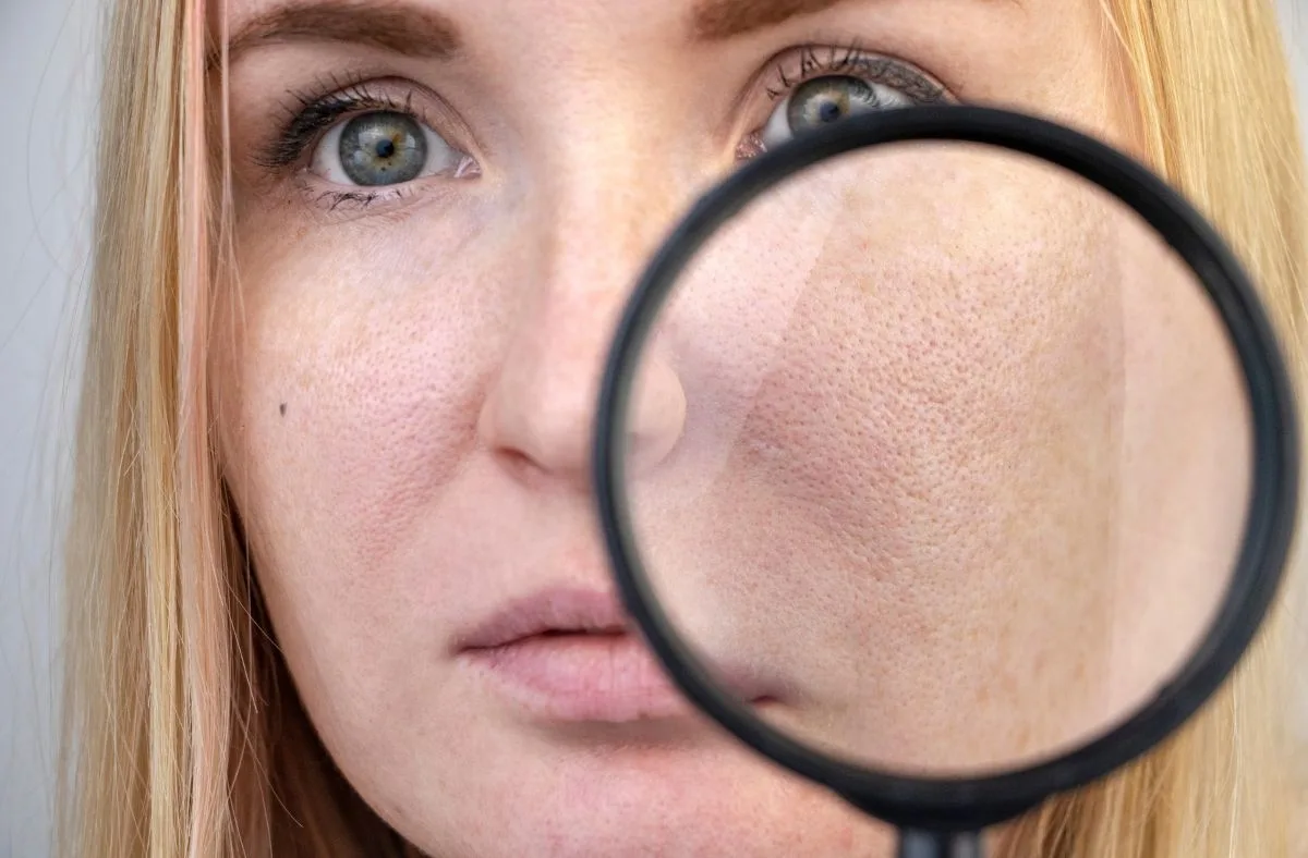 enlarged pores treatment