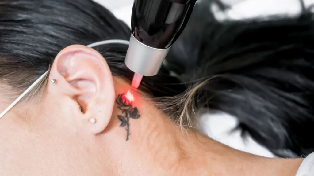 best tattoo removal in taylors, sc